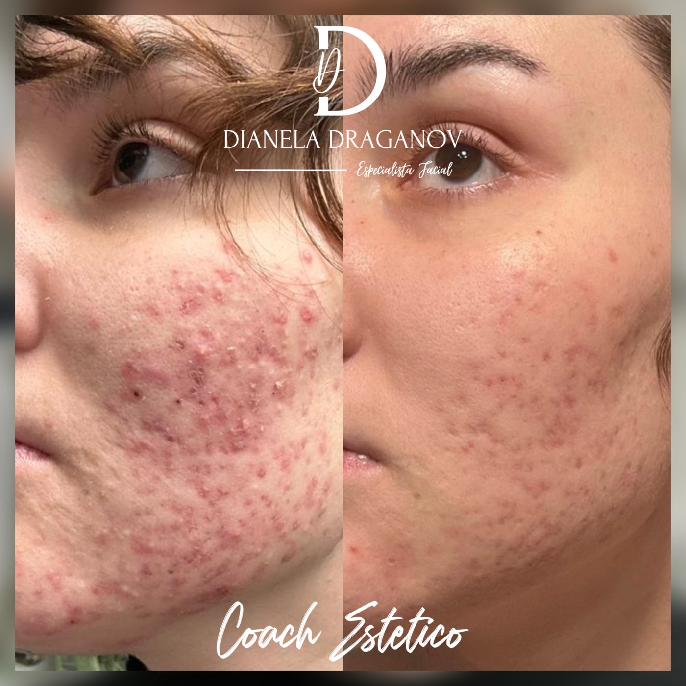 Antes y después de una técnica de aplicación de peeling químico