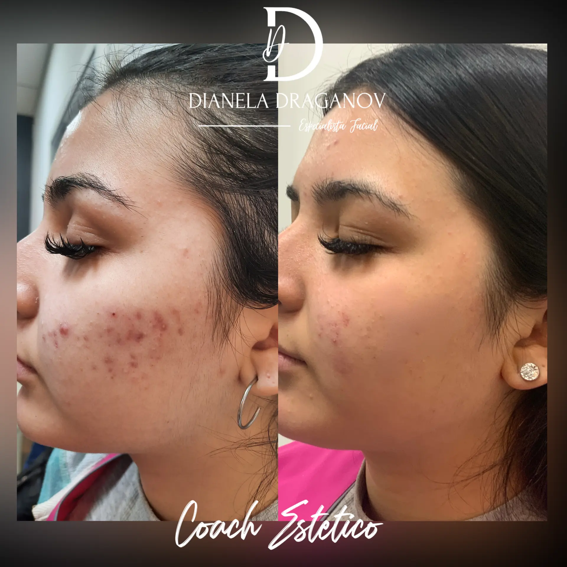 Antes y después: acné y marcas en mejilla con peeling químico