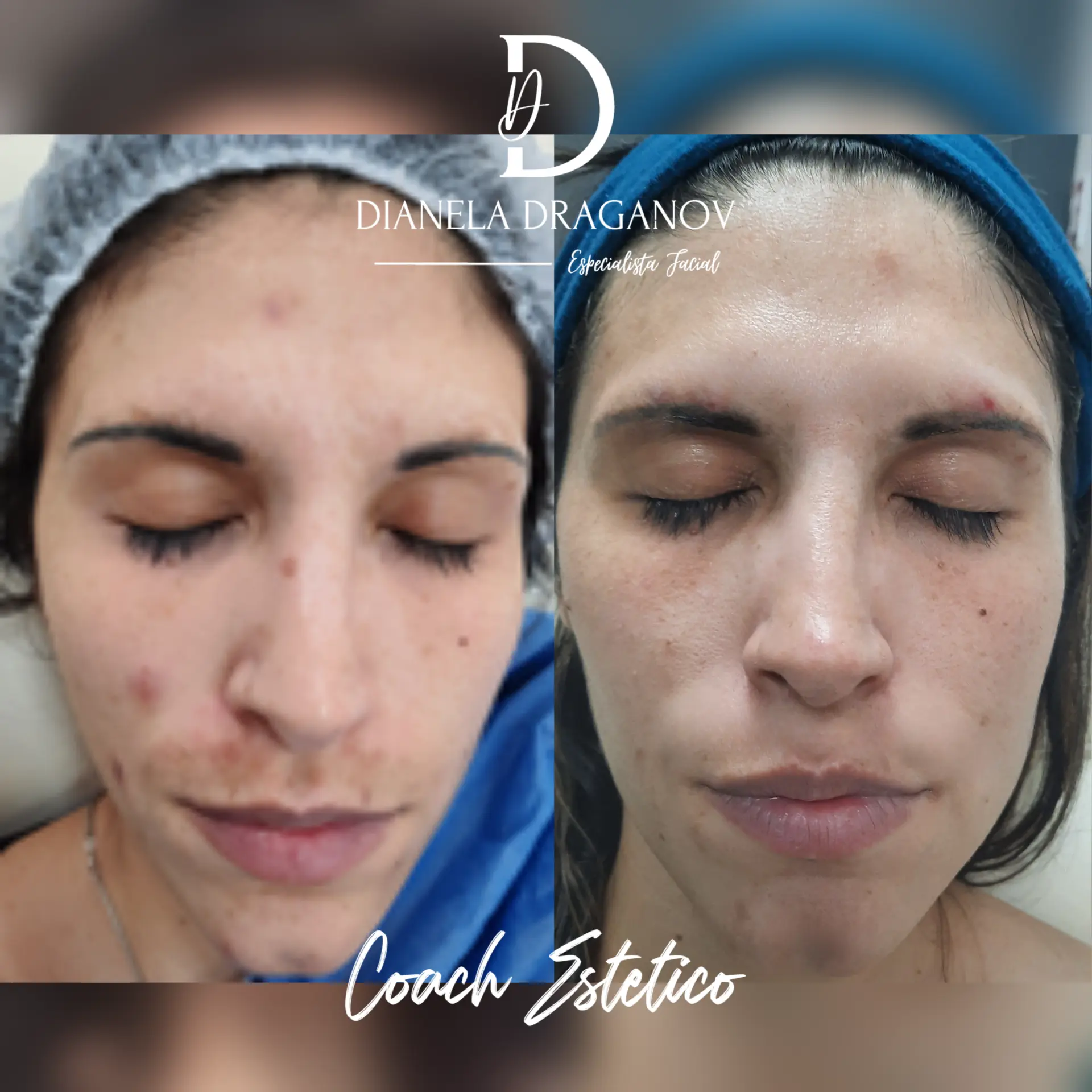 Antes y después: piel más limpia y luminosa tras peeling químico