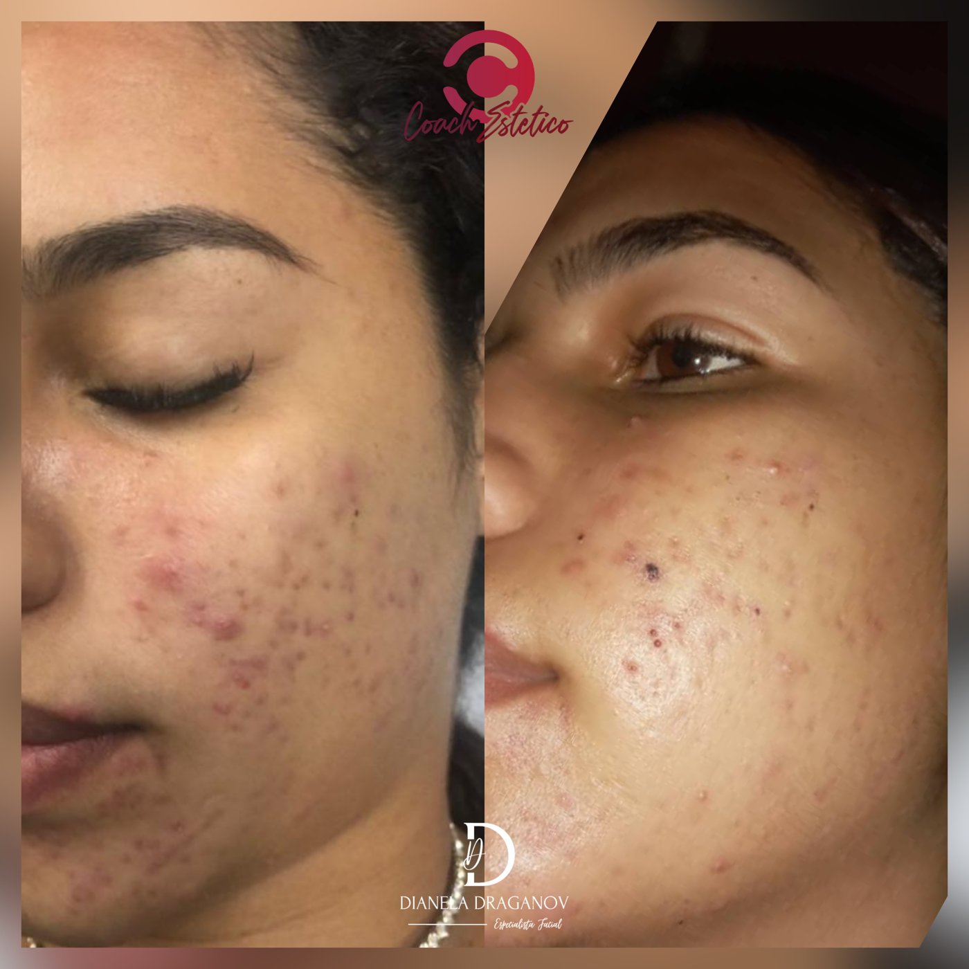 Antes y después de un protocolo de peeling químico