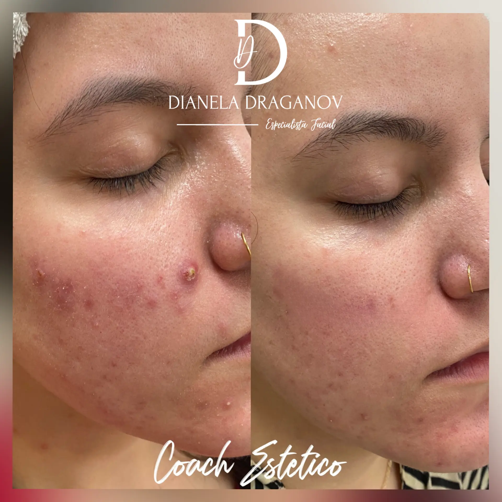 Antes y después: acné inflamatorio tratado con peeling químico