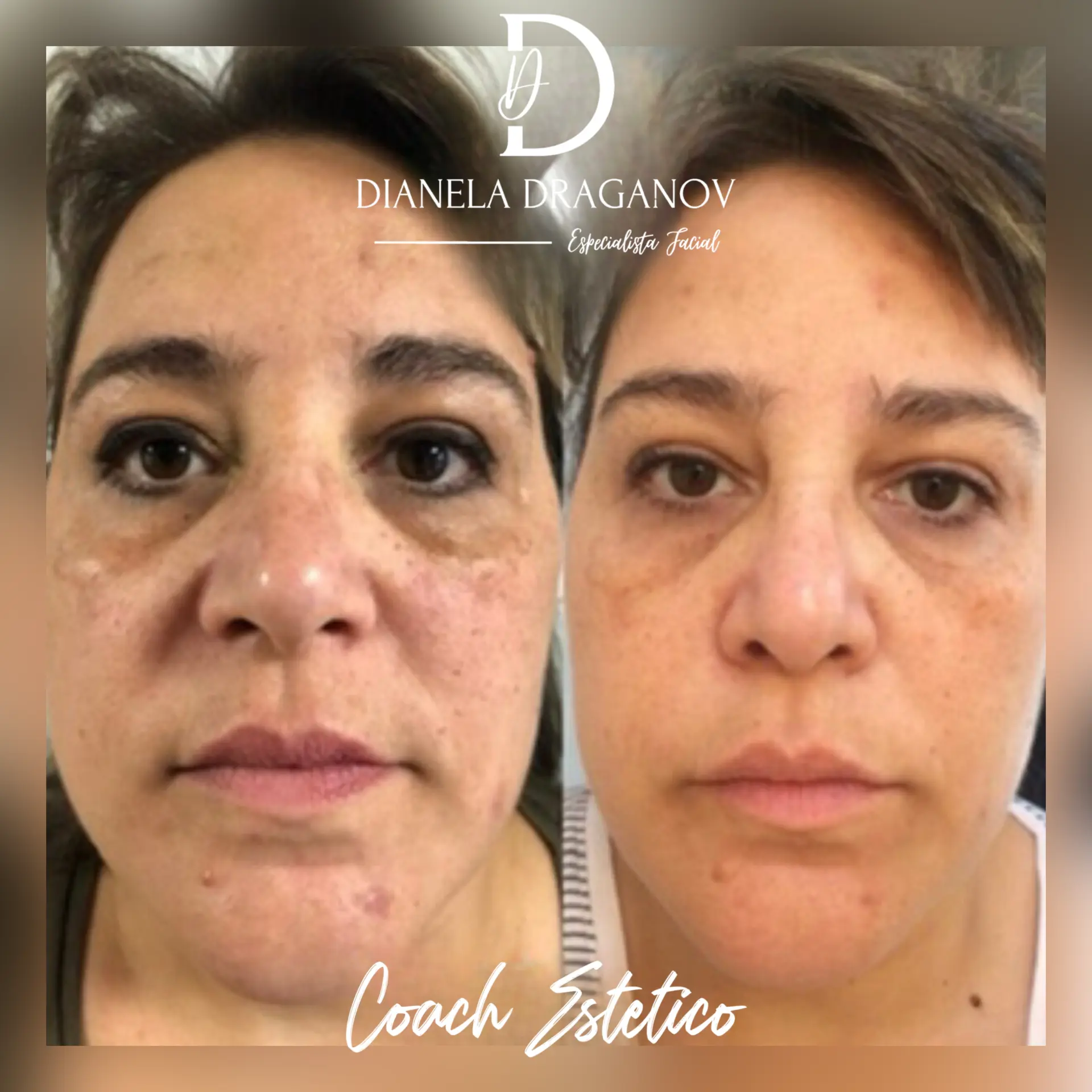 Antes y después: unificación del tono y manchas con peeling químico