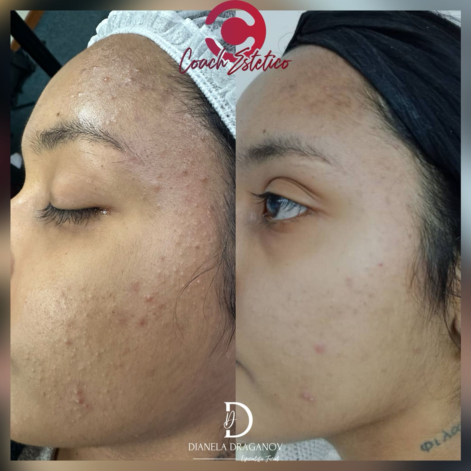 Antes y después: textura y congestión de la piel con peeling químico